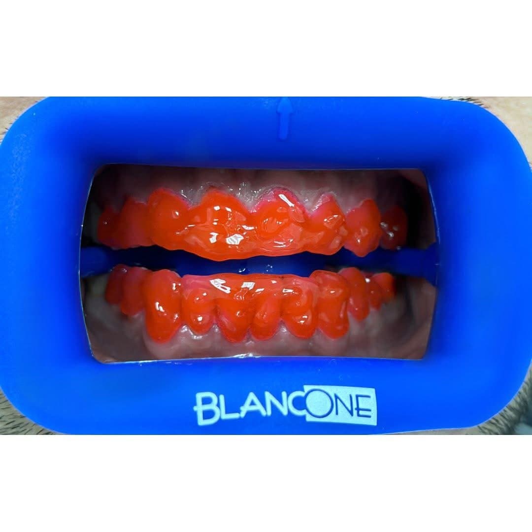 După albire BlancOne — rezultat Mazur Dent Chișinău