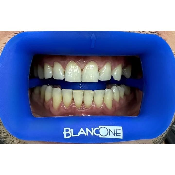 Procedura de albire BlancOne — etapă intermediară
