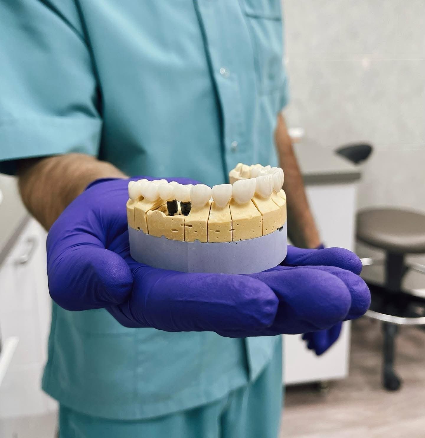 Coroane zirconiu pe model — laborator Mazur Dent