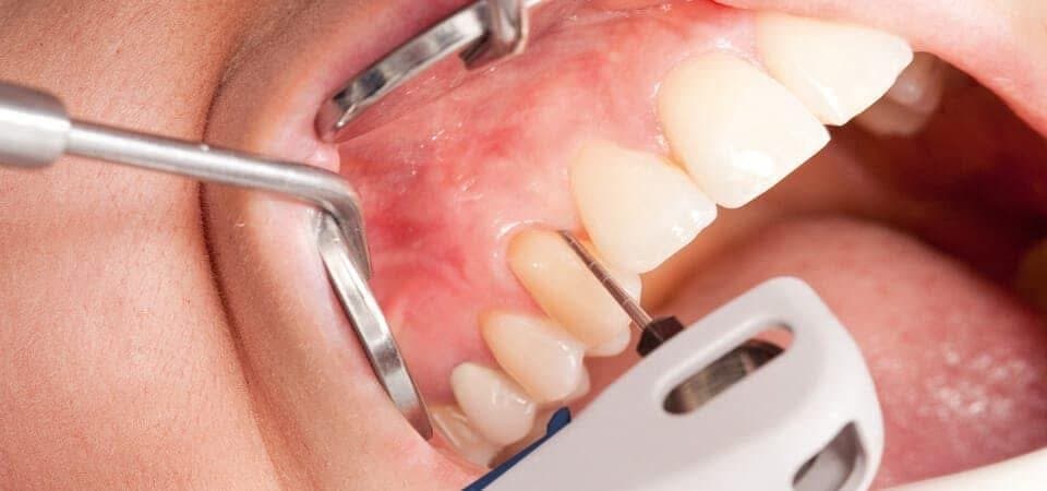 Scaler ultrasonic pentru detartraj Mazur Dent