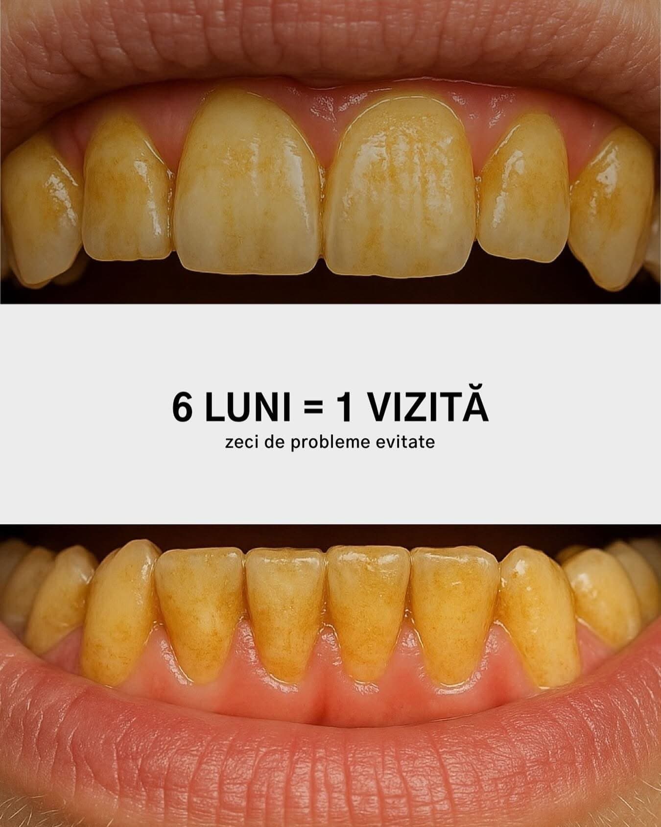 De ce este necesară igienizarea profesională la 6 luni — Mazur Dent