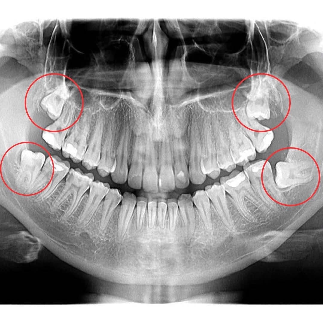 Radiografie panoramică pentru extracție măsele de minte — Mazur Dent